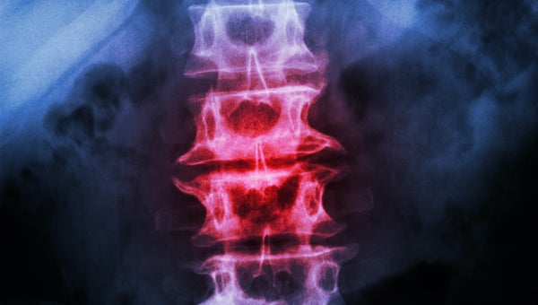 Spondylosis and Scoliosis
